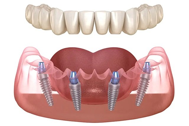 All-on-4 Dental Implants: A Solution for Full Arch Replacement